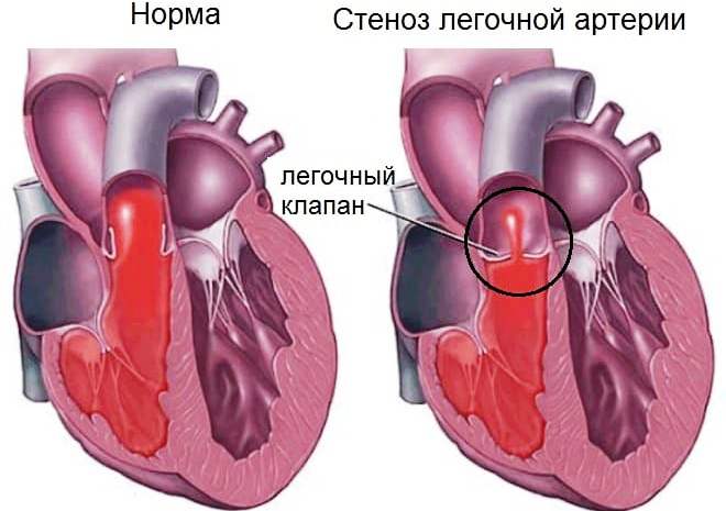 стеноз легочной артерии